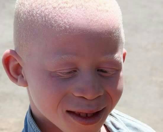 More opportunities needed for albinos – NGO