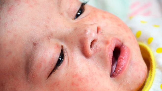 Measles ‘tragedy’ kills 35 across Europe
