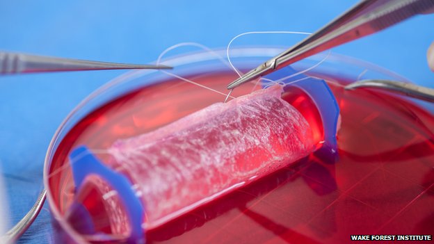 Doctors implant lab-grown vagina