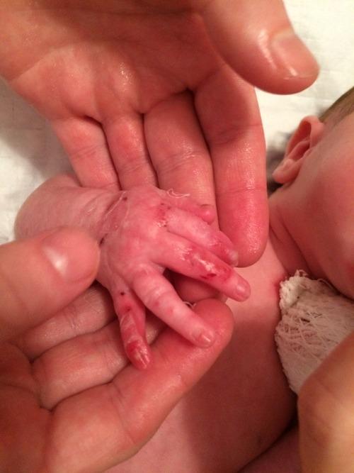 Baby with delicate skin can’t be touched