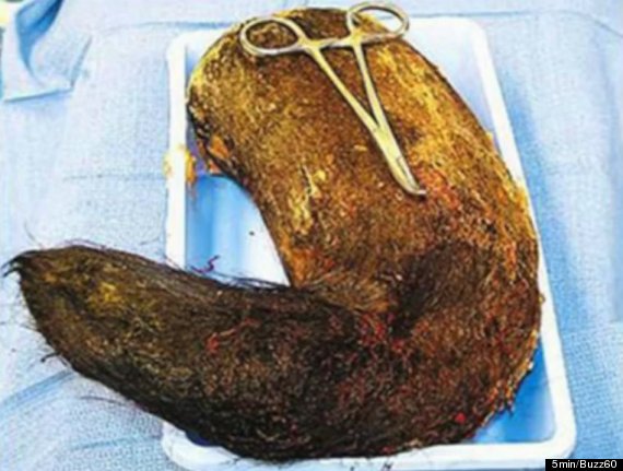 9-pound hairball removed from girl’s stomach